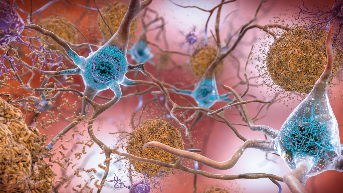 Scientists torn over Biogen's new Alzheimer's drug