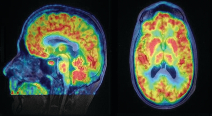 Hooker creates radiolabeled molecules that help researchers study changes in the brain at the molecular level. This positron emission tomography brain map was made with [11C]Martinostat, a molecule that binds to histone deacetylases. The highest concentrations of the molecule are red, the lowest are blue.
